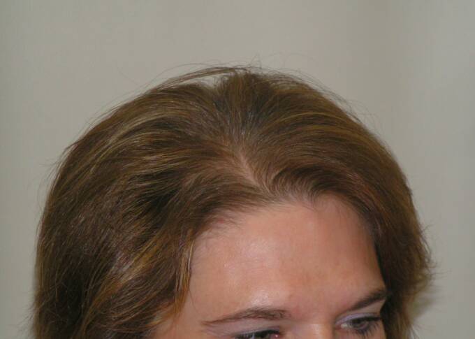 Female Hair Loss Photo 10