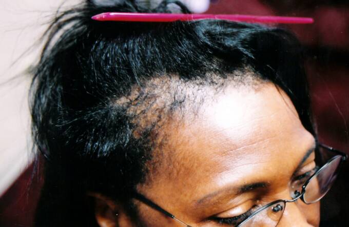 Female Hair Loss Photo 3