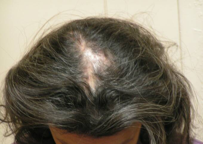 Female Hair Loss Photo 11